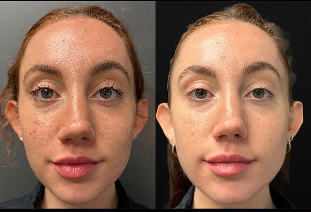Skin Rejuvenation Before & After