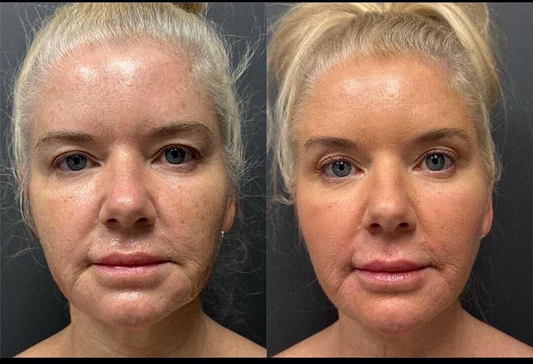 Skin Rejuvenation Before & After