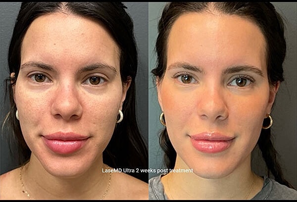 Skin Rejuvenation Before & After