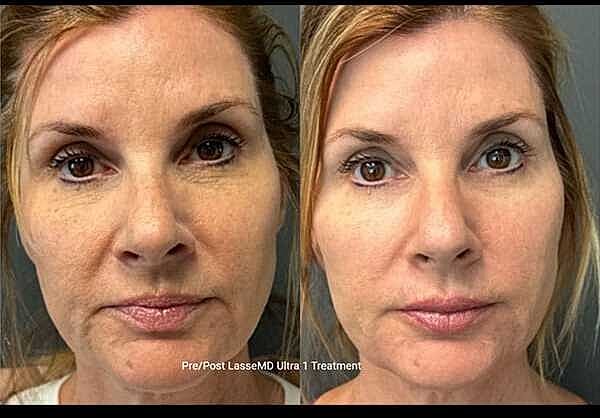 Skin Rejuvenation Before & After
