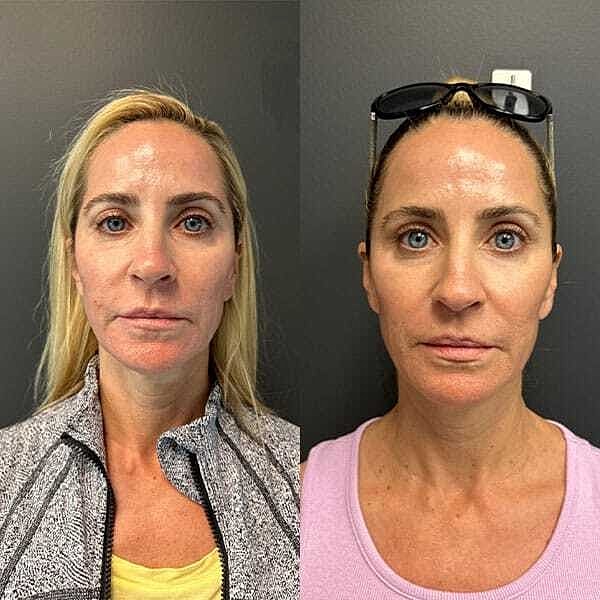 Skin Rejuvenation Before & After