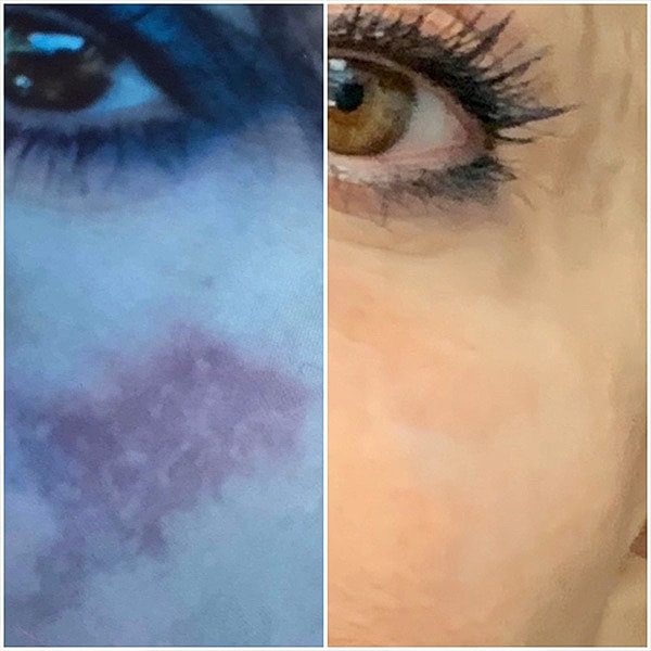 Hollywood Laser Peel Before & After