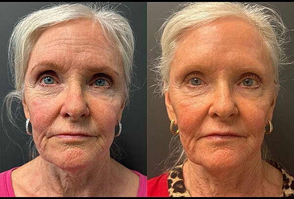 Skin Tightening Before & After