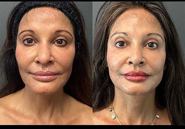 Skin Tightening Before & After