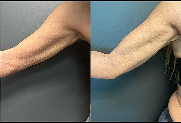 Skin Tightening Before & After