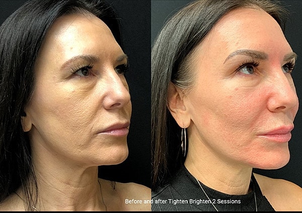 Skin Tightening Before & After