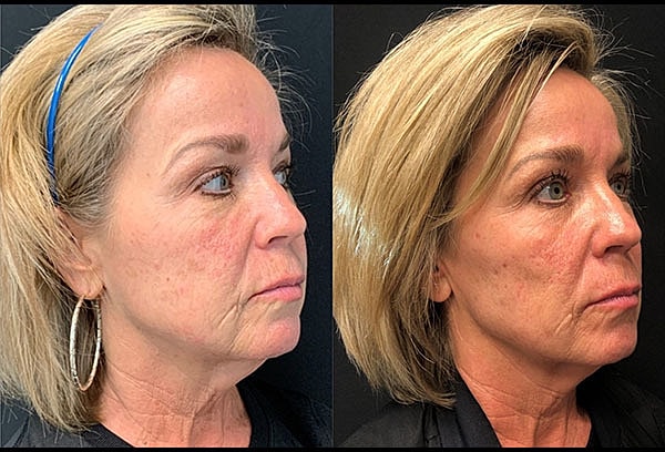 Skin Tightening Before & After