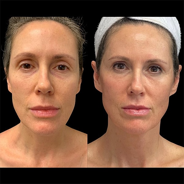Skin Tightening Before & After