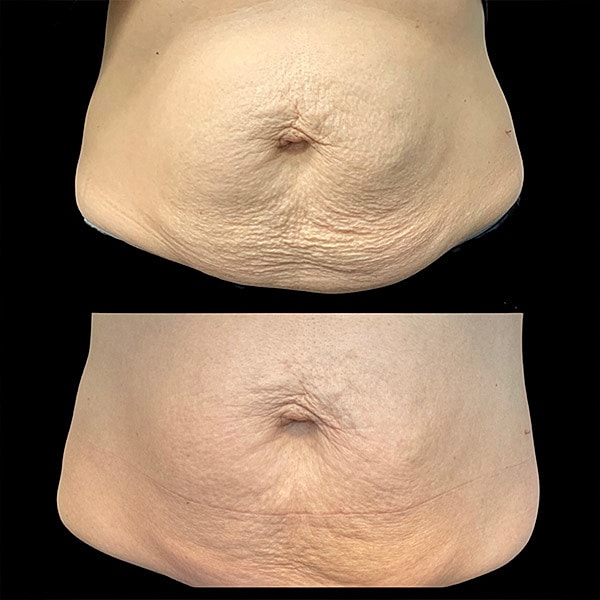 Skin Tightening Before & After