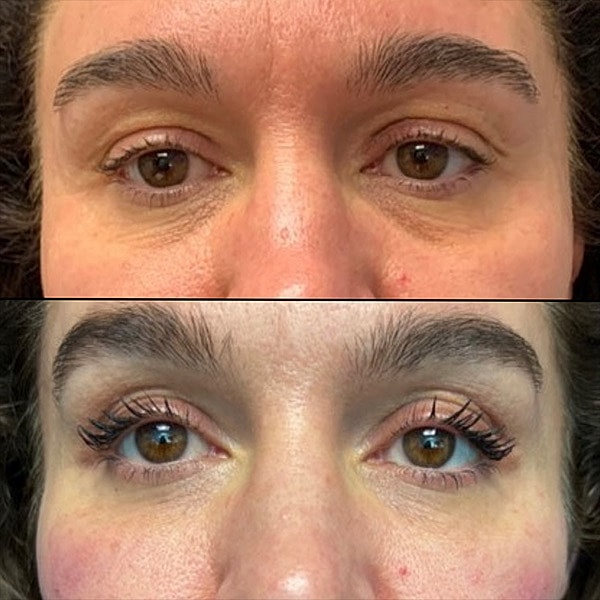 Skin Tightening Before & After