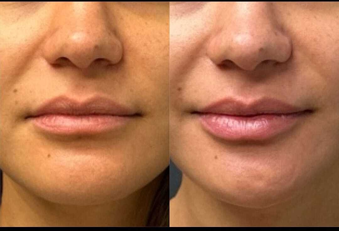 Lips Before & After