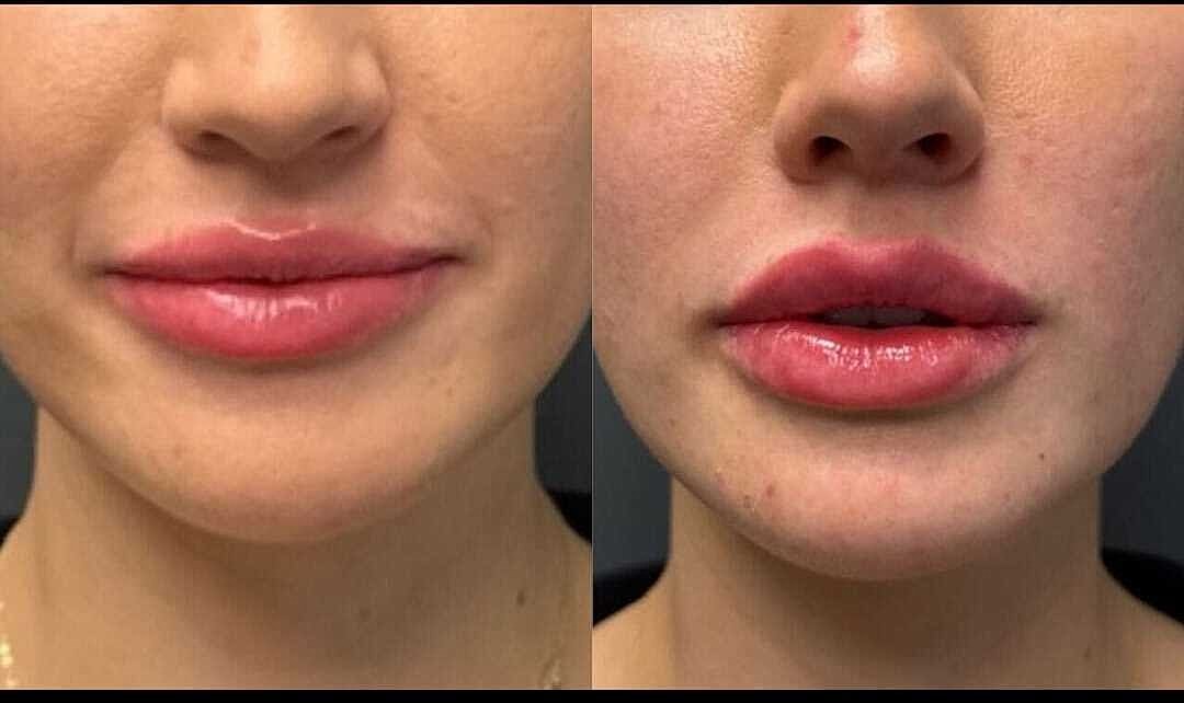 Lips Before & After
