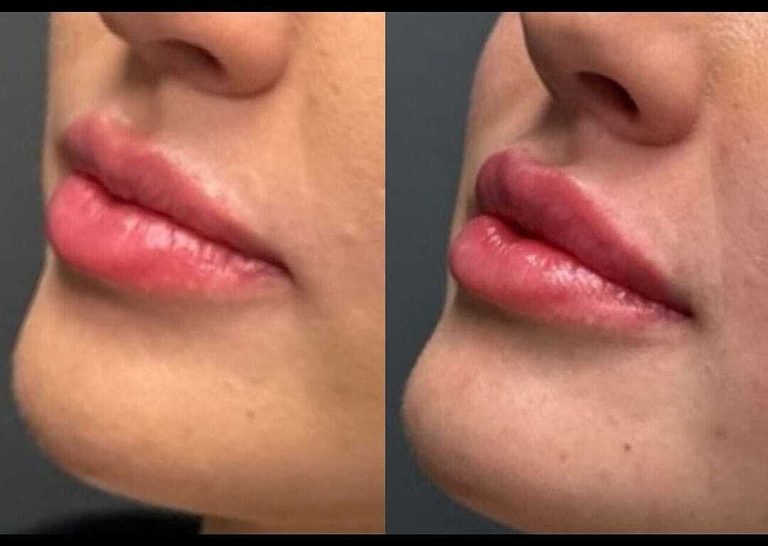Lips Before & After