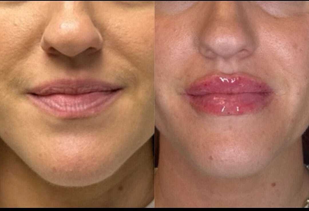 Lips Before & After