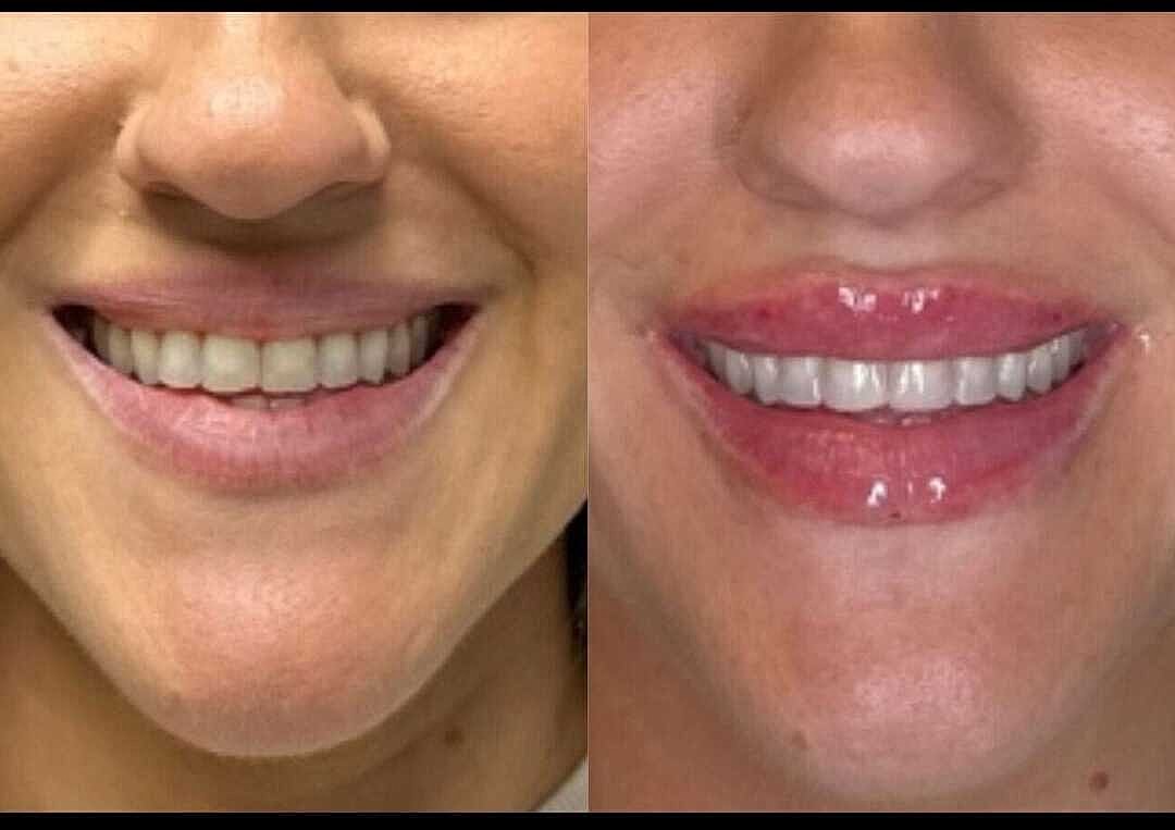 Lips Before & After