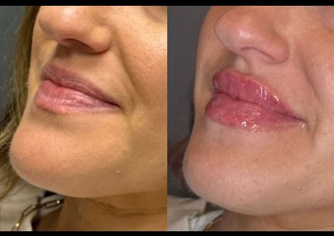 Lips Before & After