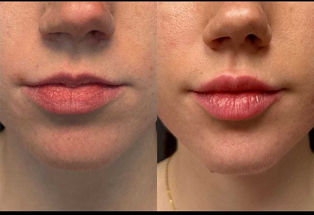 Lips Before & After