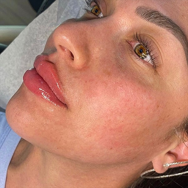 Lips Before & After