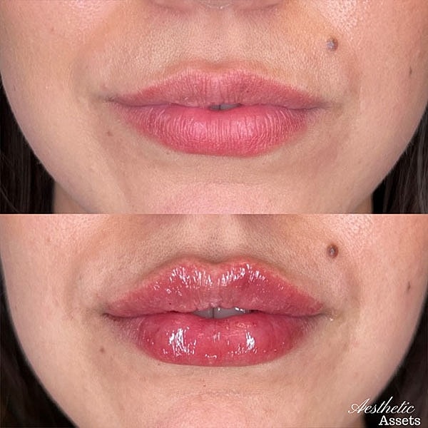 Lips Before & After