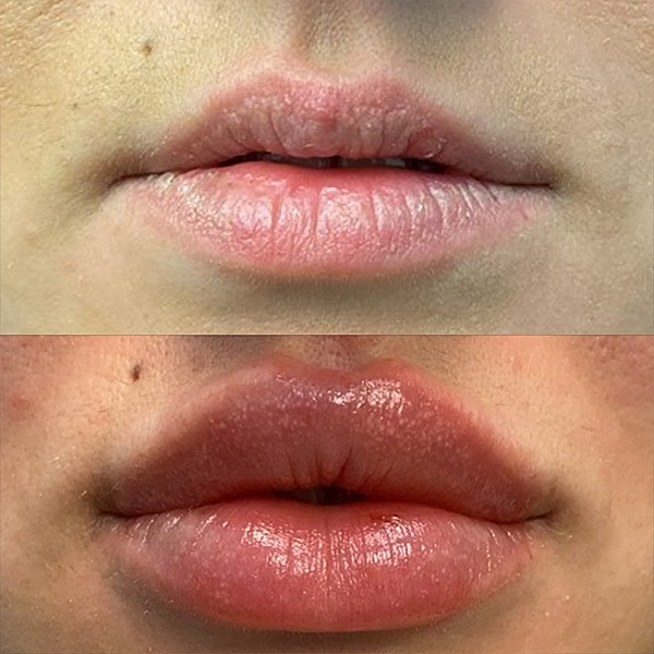 Lips Before & After