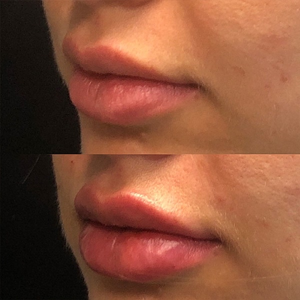 Lips Before & After