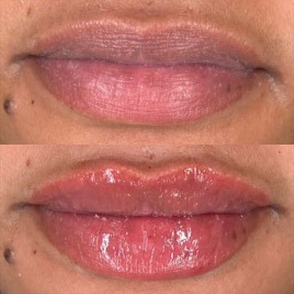 Lips Before & After