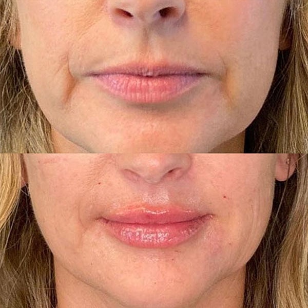 Lips Before & After
