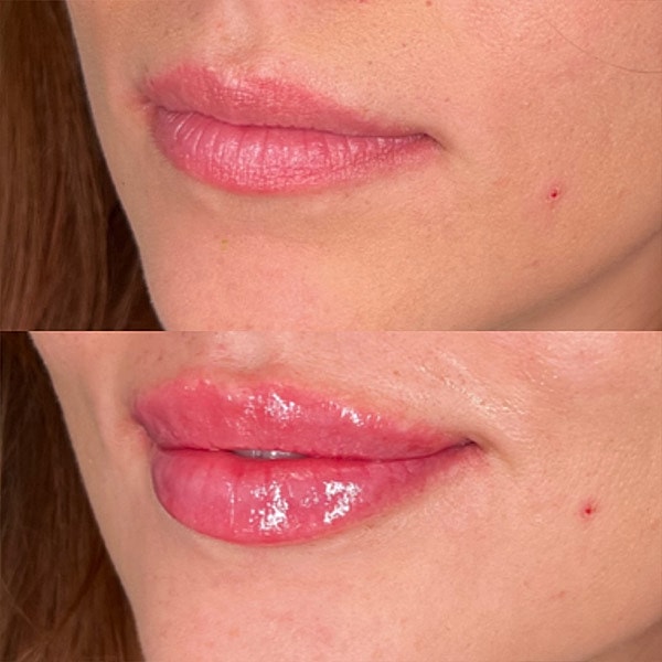Lips Before & After