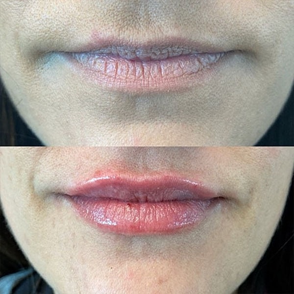 Lips Before & After