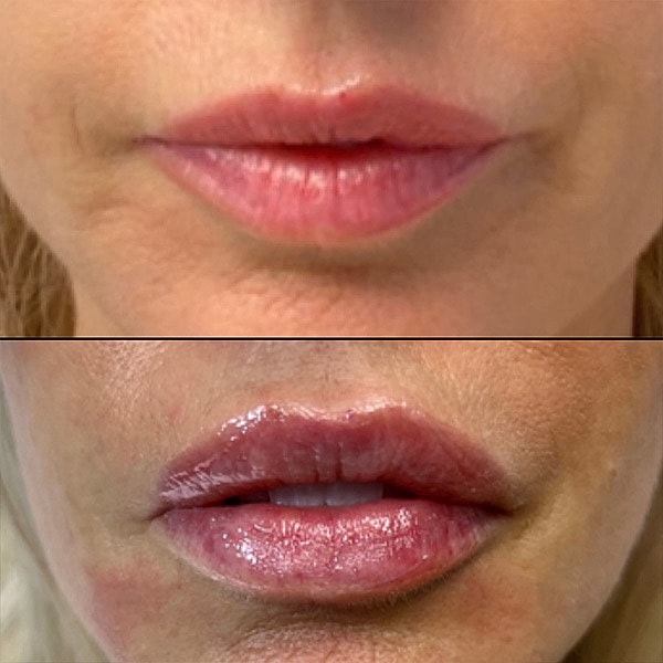 Lips Before & After