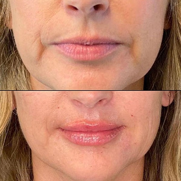 Lips Before & After