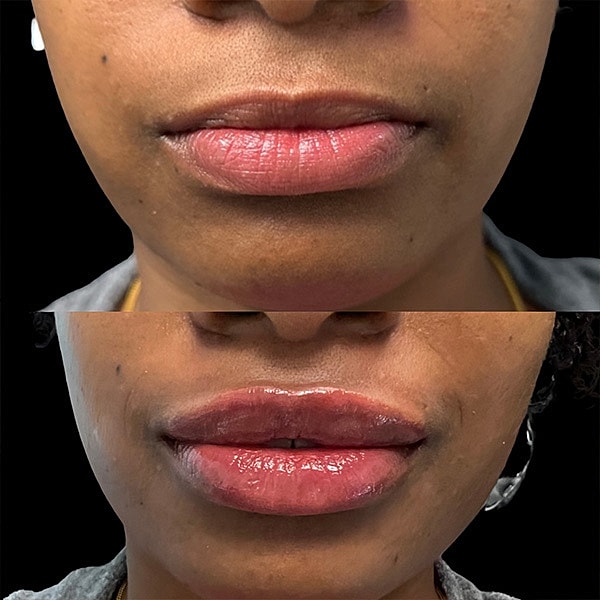 Lips Before & After