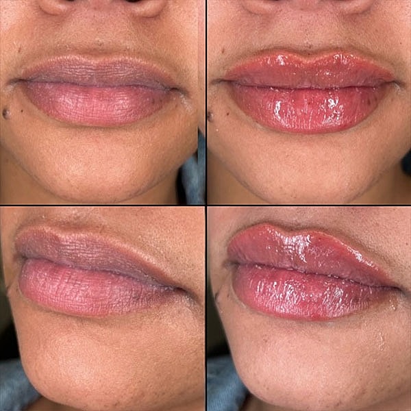 Lips Before & After