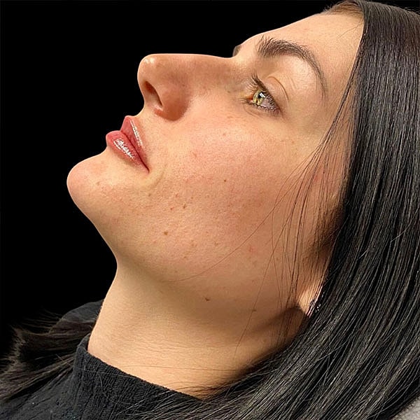 Lips Before & After