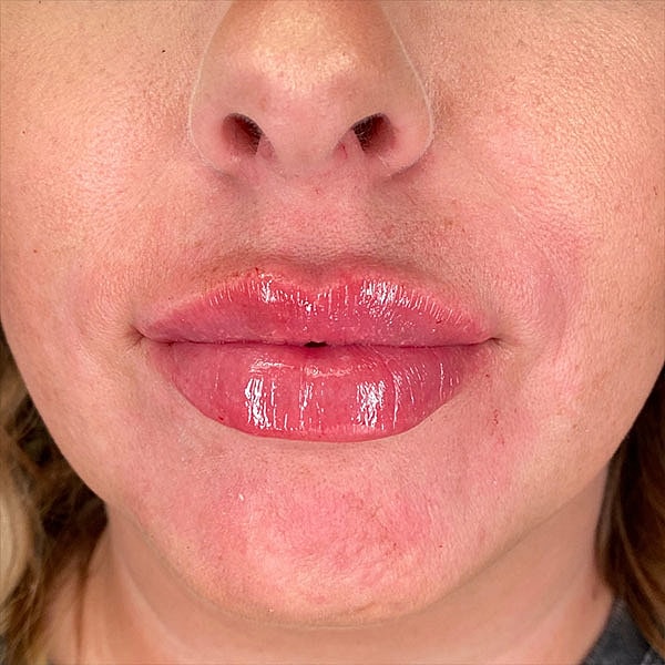 Lips Before & After