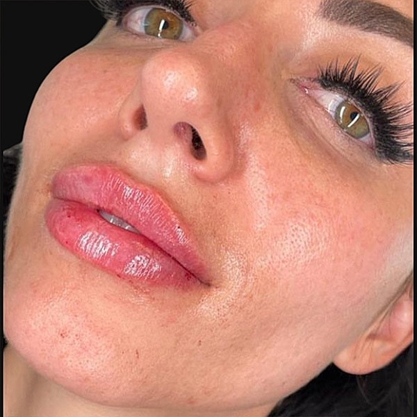 Lips Before & After