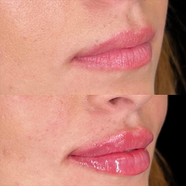 Lips Before & After