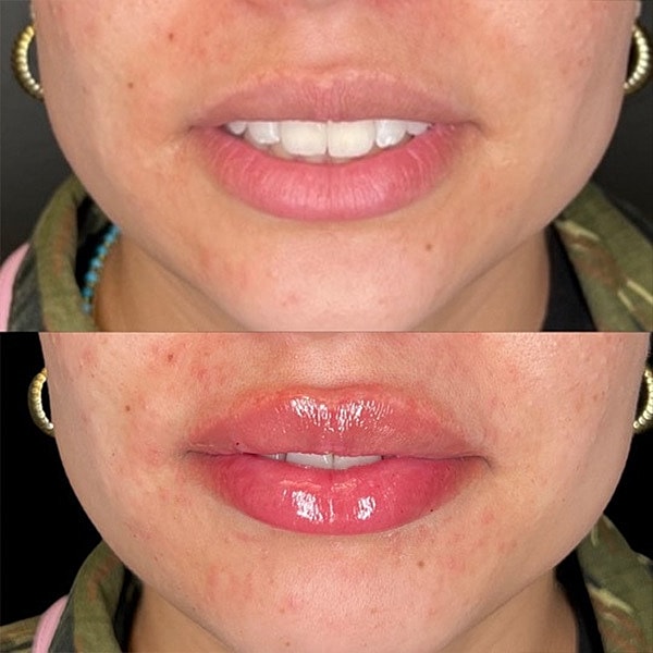 Lips Before & After
