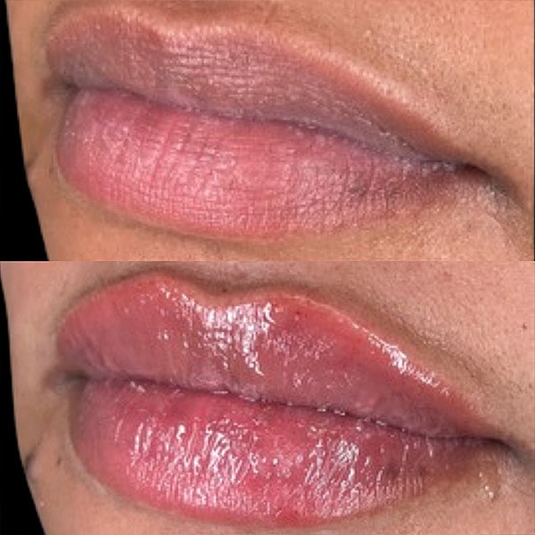 Lips Before & After