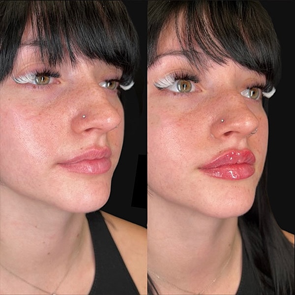 Lips Before & After