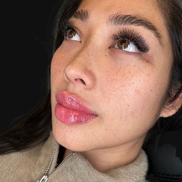 Lips Before & After