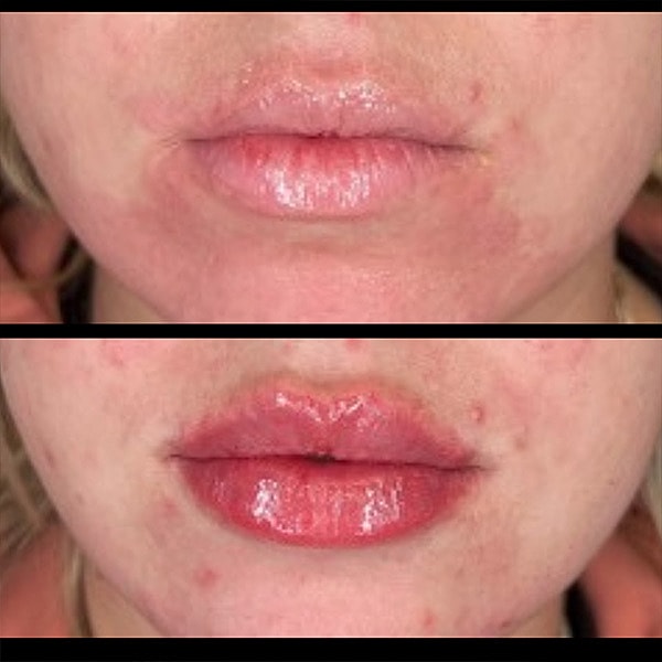 Lips Before & After
