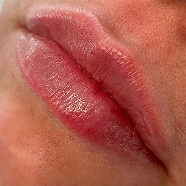 Lips Before & After