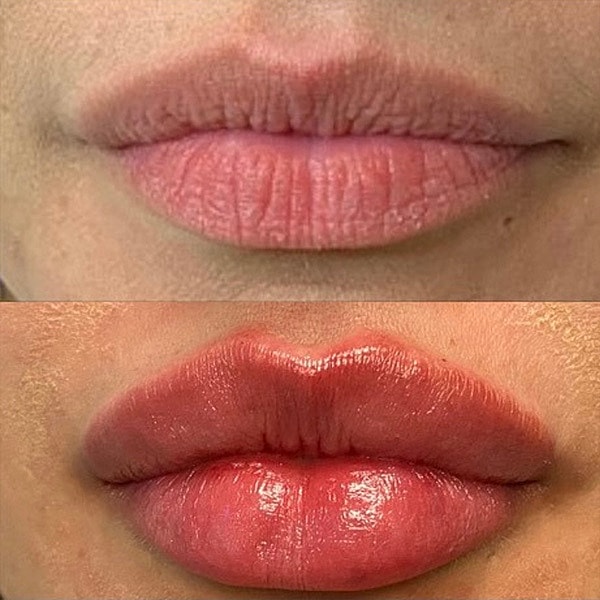 Lips Before & After