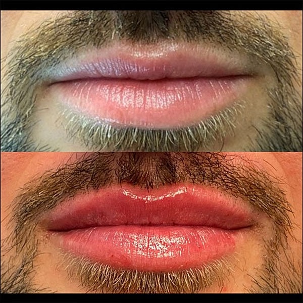 Lips Before & After