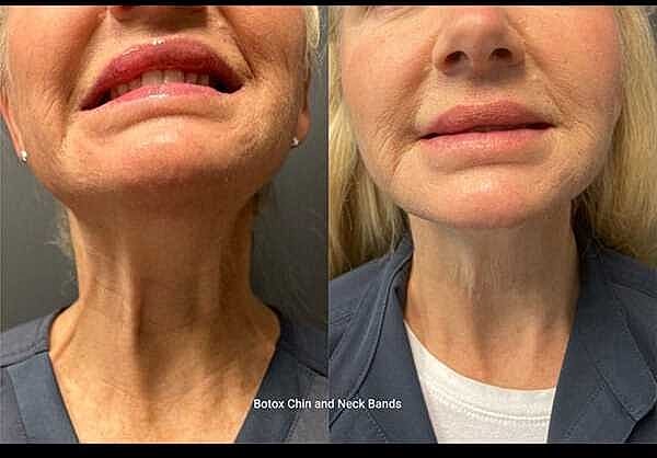 Botox Before & After