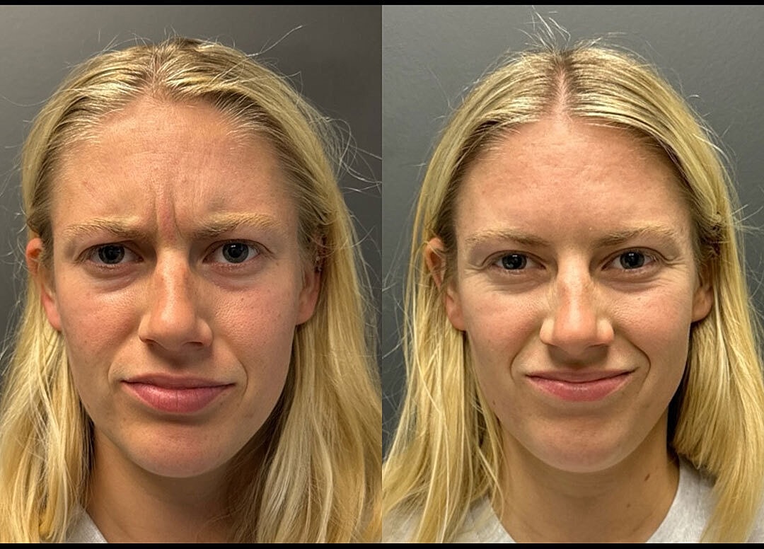 Botox Before & After