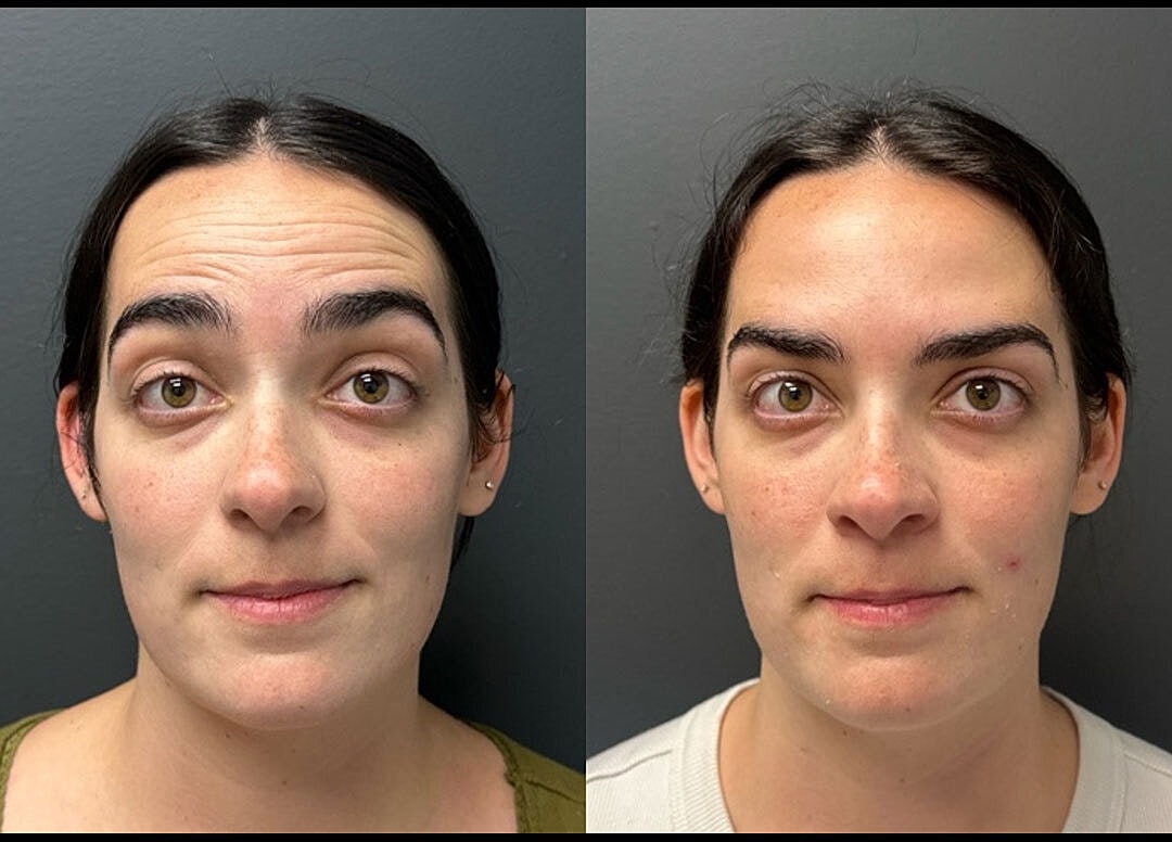 Botox Before & After