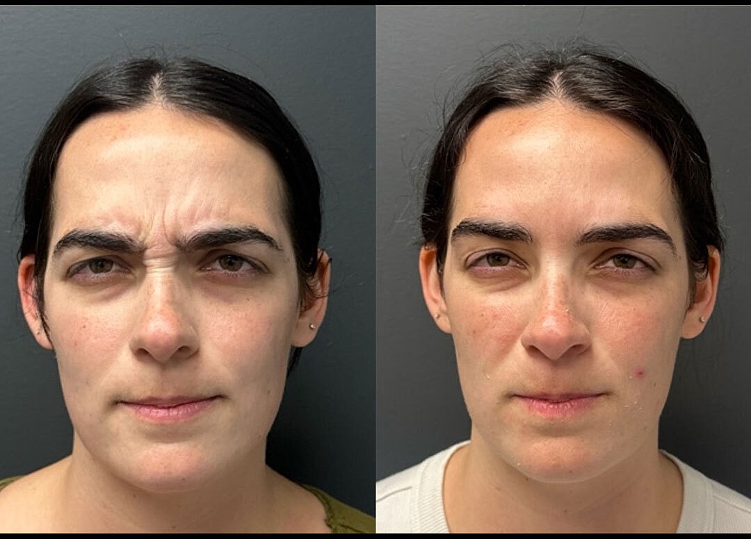 Botox Before & After
