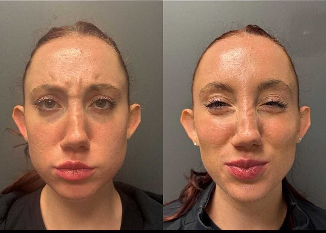 Botox Before & After